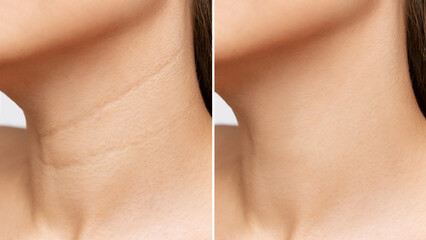 Сlose-up of young woman's neck with wrinkles before and after treatment. Result of cosmetic...