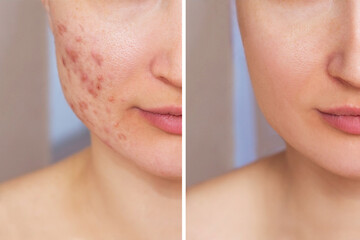 Cropped shot of a young woman's face before and after acne treatment. Pimples, red scars on the...