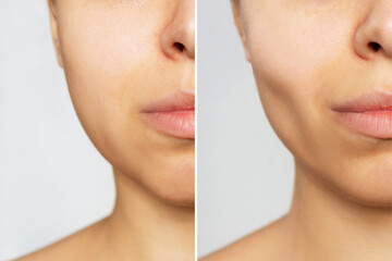Cropped shot of young woman's face before and after plastic surgery buccal fat pad removal on a...