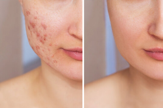 Cropped shot of a young woman's face before and after acne treatment. Pimples, red scars on the girl's cheeks. Problem skin, care and beauty concept. Dermatology, cosmetology