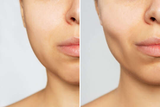Cropped shot of young woman's face before and after plastic surgery buccal fat pad removal on a white background. A lower part of face with clear highlighted cheekbones. Result of cosmetic surgery