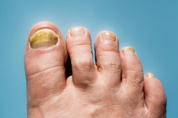 Onychomycosis, a nail disease caused by pathogenic fungi.