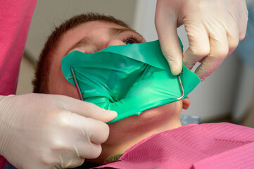 The dentist installs a rubber dam and a clamp for the treatment of a diseased tooth.