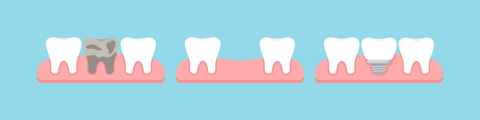Dead tooth, lost stage and dental implant in gum isolated on blue background. Healthy human teeth and implant prosthesis concept. Flat design cartoon style vector orthodontist dentistry illustration.