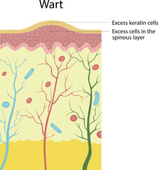 Vecro illustration structure of wart. Excess keratin cells. Excess cells in the spinous layer