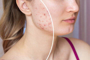 Cropped shot of a young woman's face before and after acne treatment. Pimples, red scars on the...