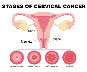 Flat illustration of cervical cancer stages. Diseases of the female reproductive system.Cervical canal, cervix, vagina. Carcinoma, malignant neoplasm.Biology, anatomy, medicine and scientific concept.