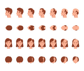 Stages of Baldness of Men and Women. Male and Female Characters Head Top, Side and Front View with Hair Loss Process