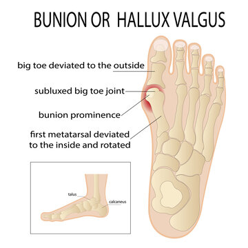 Bursitis on the sides of the foot. The bone and skin on the sides of the big toe joint form an abnormal foot shape. Common problem