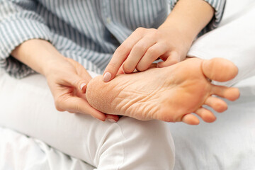 Dry cracked skin of feet and heels. Peeling, cracks and cornea sole of the foot. Dryness,...