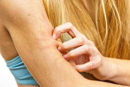 Woman scratching her itchy arm. Skin allergy.