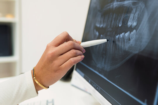 Dentist analyzing teeth X-ray over intraoral scanner screen in clinic
