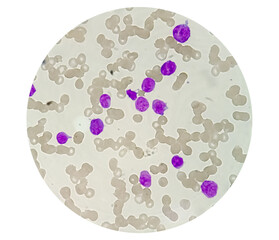 1000x, abnormal, acute, all, aml, analyzing, apl, blast, blood, bone, cancer, care, cbc, cell,...