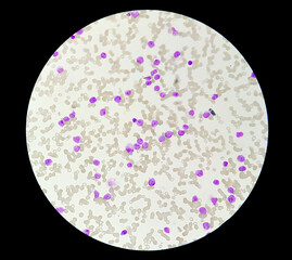 1000x, abnormal, acute, all, aml, analyzing, apl, blast, blood, bone, cancer, care, cbc, cell,...
