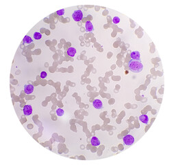 1000x, abnormal, acute, all, aml, analyzing, apl, blast, blood, bone, cancer, care, cbc, cell,...