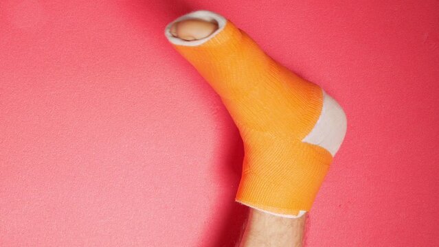 Foot with broken toe bone in orange fiberglass cast pink background. Injured fractured swollen male leg in modern orthopedic waterproof cast made of synthetic thermoplastic glass cloth Patient body 4K
