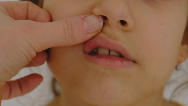 The child has stomatitis on the tongue. Selective focus.