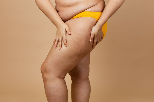Cropped photo of woman body excess orange skin in yellow underwear, treatment of obesity cellulite on hips, buttocks. Overweight fat folds hanging. Big size. Hold flabs. Liposuction surgery, massage