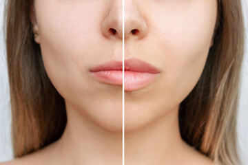 Result of lip augmentation. Cropped shot of young blonde woman's face with lips before and after...