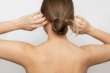 Close-up of a female back and arms with a large number of moles isolated on a gray background. The...