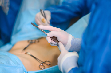 Laparoscopic surgery using an endoscope. Modern surgery. Minimally invasive surgery