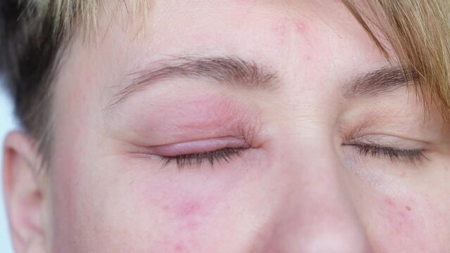 Close Up of Adult woman with Inflamed Eye Looking at Camera.