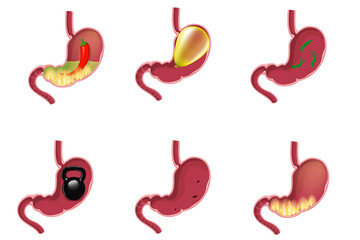 Healthy and unhealthy, empty and full human stomach in trendy flat style. Nutrition, stomach pain, bloating. Digestive system anatomy. Vector illustration isolated on white background.