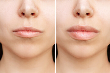 Result of lip augmentation. Cropped shot of young woman's face with lips before and after lip enhancement. Injection of filler in lips - obrazy, fototapety, plakaty