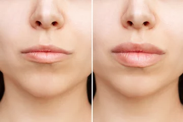 Fotobehang Result of lip augmentation. Cropped shot of young woman's face with lips before and after lip enhancement. Injection of filler in lips © Марина Демешко