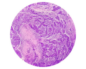 Photomicrograph of Nasopharyngeal carcinoma, nasopharynx cancer, most common cancer originating in the nasopharynx