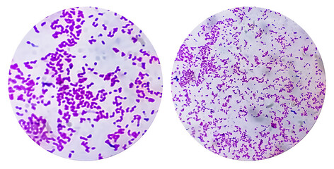Photo collage of two microscopic image of Escherichia coli bacterium, E.coli, gram-negative...