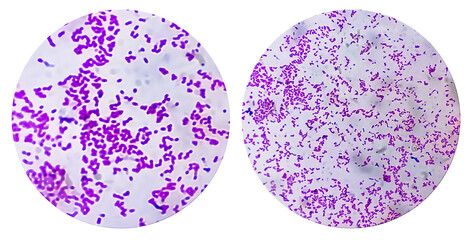 Photo collage of two microscopic image of Escherichia coli bacterium, E.coli, gram-negative...