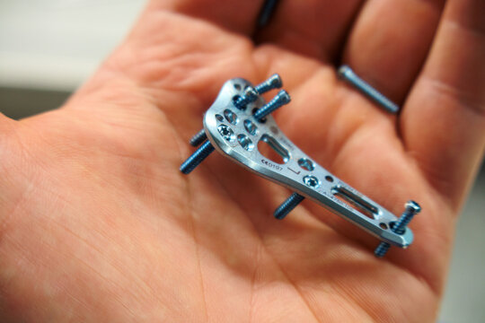 explanted surgical blue titanium radius plate lies in one hand