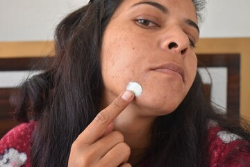 Indian Woman applying Neem face cream on acne