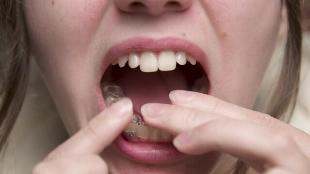 Mouth close-up A young woman puts a corrective aligner splint on her lower teeth to correct an overbite while looking in the bathroom mirror. Installation of aligners