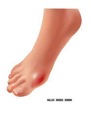 Arthritic hallux rigidus bunion rheumatoid sore joints, top view.