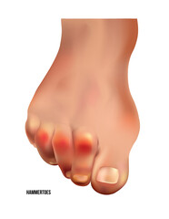 Realistic hammer toes of human leg with red pain points frontal view.