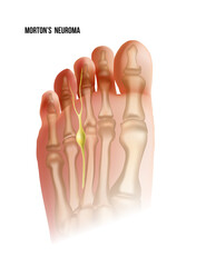 Mortons neuroma. Foot pain strain bottom view. Realistic anatomy illustration