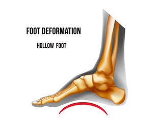 Foot hollow arch deformation. Bones skeleton realistic anatomy illustration