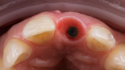 macro dental photo through the mirror on the abutment of the central tooth after implantation