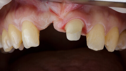 upper jaw without a central tooth and a prepared tooth for a crown © Dental Pro Content