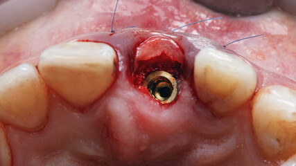 view of the installed abutment dental and soft tissue graft in the area of the central tooth
