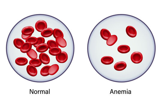 Diagram of comparison between normal red blood cells and anemia.
