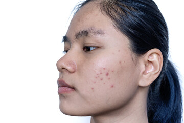 Close up of young Asian woman worry about her face when she has problems with skin on her face....