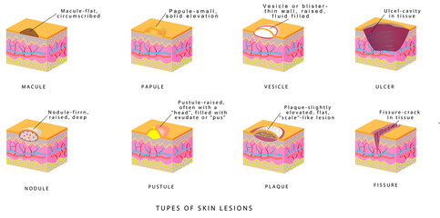 Types of skin lesions. Dermatology - Primary & Secondary Skin lesions. Skin Lesion - Cyst, Fissure, Macule, Nodule, Papule, Polyp, Pustule, Vesicle, Wheal 

