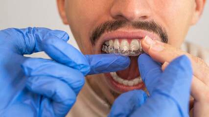 Man dentist applying invisible aligner on male patient teeth at modern clinic