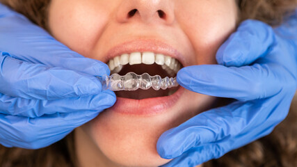 Dentist in gloves applying invisible aligner on female patient teeth at clinic