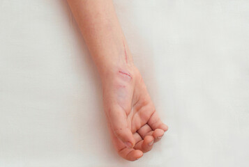 Deep wounds, scratches, abrasions on the child's arm, close-up. A palm with a fresh cut wound on a child's hand on a white background. An image with selective focusing