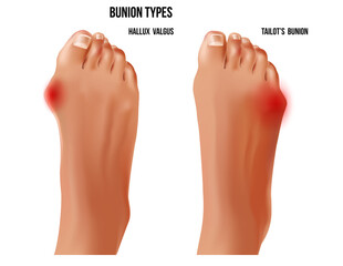 Artritic tailors bunion and hallux valgus foot bunion rheumatoid sore joints, top view.