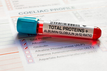 Blood sample tube for analysis of Total Proteins + Albumin and Globulin A/G Ratio screening test in laboratory. Blood tube test with requisition form for Total Proteins + Albumin and Globulin A/G Rati